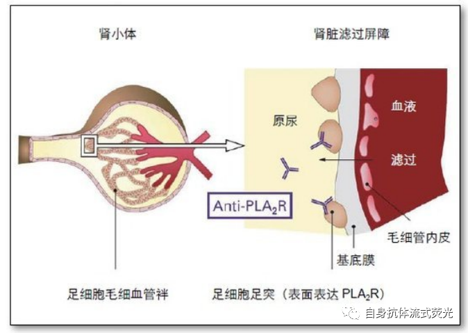 2022-04-15-自免-抗PLA2R抗体，你知多少-图1-肾小体.png